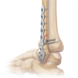 Distal Fibula Ankle Fracture | Arthrex: Complex Fibular Fracture Plate (Locking Distal Fibular ...