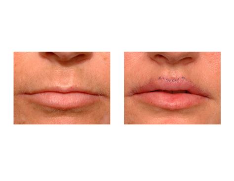 Bildergebnis für top+lip+surgeons