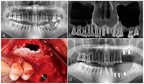 Maxillary Sinus Perforation During Root Canal Treatment