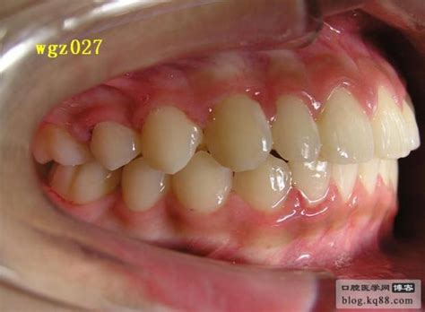 拔牙好几年了还能种牙吗？可以，但要符合种植牙条件 - 口腔资讯 - 牙齿矫正网