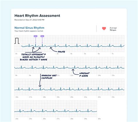 Premature Atrial Contraction (Couplet) Vs. Supraventricular Tachycardia ...