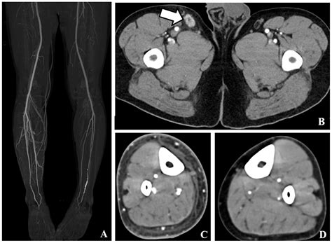 Computed Tomography Imaging Characteristics in the Diagnosis and ...