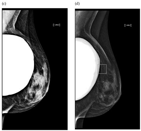 Two-Dimensional Mammography Imaging Techniques for Screening Women with Silicone Breast Implants ...