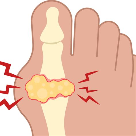 URIC ACID - Causes, Symptoms & Treatments with Herbal | Ayurvedic | Su ...