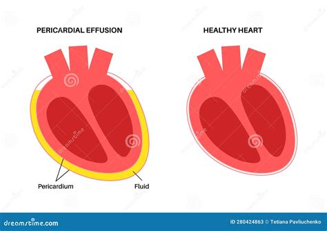 Cardiac Tamponade Diagram Cardiac Tamponade — Inside The Silver