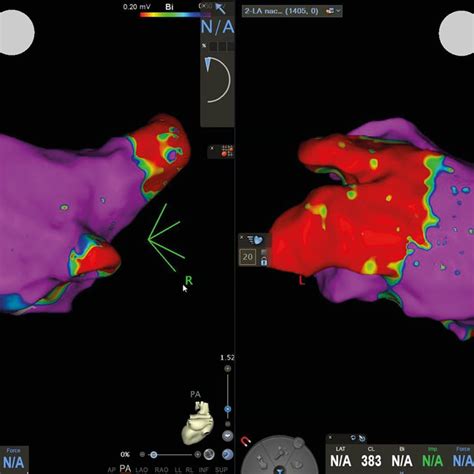 Innovationen in der Katheterablation von Vorhofflimmern - Kardiologie ...