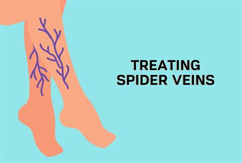 Spider Veins From Sitting Too Much at Kent Kahn blog