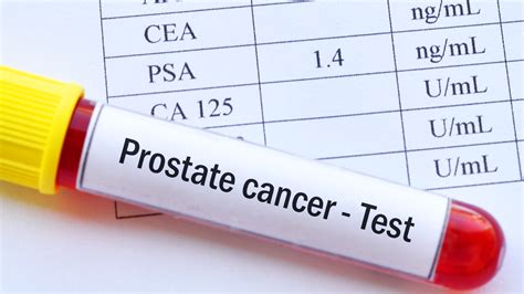 Prostate Health: How to Lower Your PSA Levels Naturally - firstScan