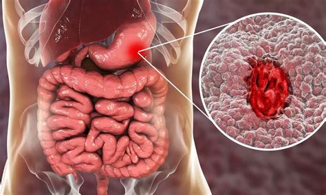 Erythromycin use prior to endoscopy improves gastric mucosa visualisation