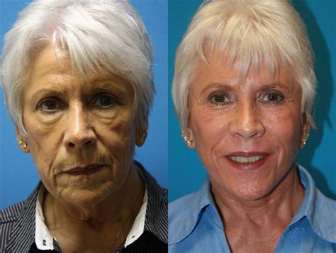 Facelift Before and After Pictures Case 70 | Charleston, SC | Crantford Costa Plastic Surgery