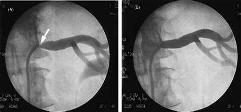 Renal Artery Stenting for Renal Artery Stenosis: Interventional Approach and Initial Clinical ...