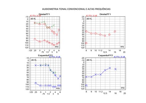 Qual a importância do exame de audiometria em altas frequências e para que ele serve? - FONOTOM