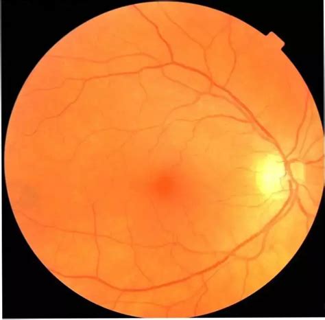 Simple eye exam could lead to early diagnosis of Parkinson's disease