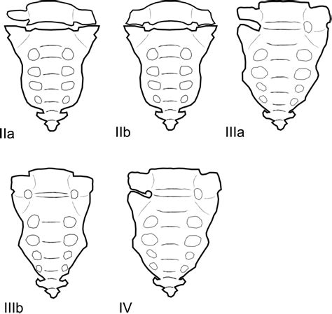 Lumbosacral Transitional Vertebrae