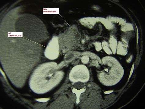 Mesenteric venous thrombosis, causes, symptoms, diagnosis, treatment & prognosis
