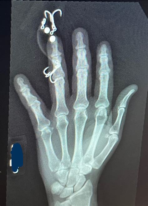 PA hand fishing lure stuck in 4th digit : r/Radiology
