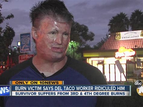 6th Degree Burn Survivor