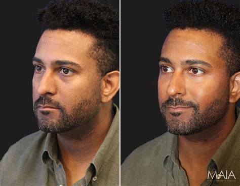 Washington DC Under-Eye Filler Before and After Pictures | Tysons Corner