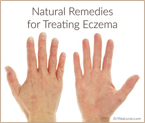 Natural Remedies for Eczema: Both Internal and External Tips