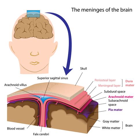 Meningitis Diagram