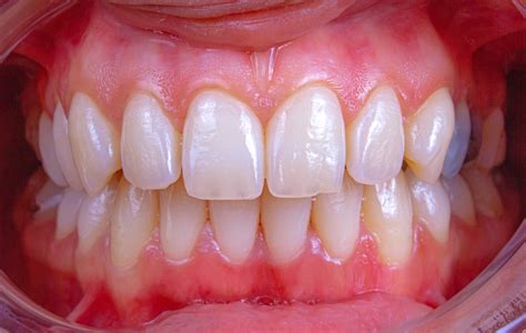 Possible Ways to Grow Back Your Teeth: Injection Research & Developments