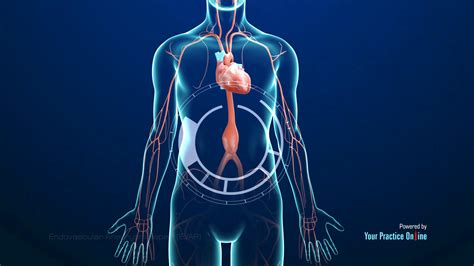 Endovascular Aneurysm Repair (EVAR) Video | Medical Video Library