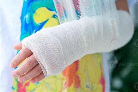 Close-up of a broken arm of a child in a cast. The girl holds her hand bent 38338963 Stock Photo ...