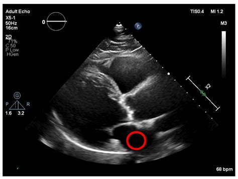 Calcium Identification and Scoring Based on Echocardiography. An ...