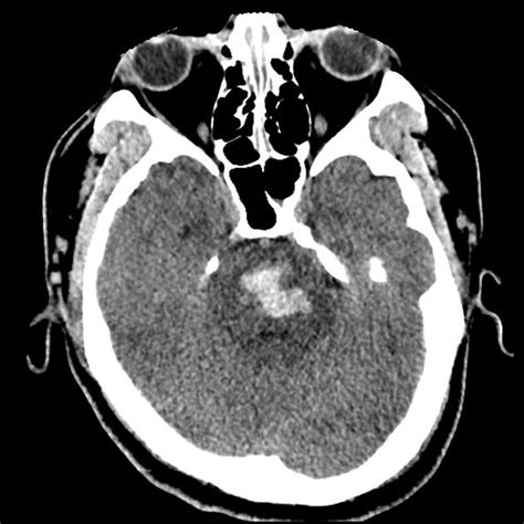 Pontine Hemorrhage: A Dreaded Complication of Chronic - MEDizzy - hemorrhage in pons