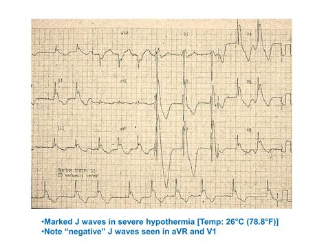 OSBORN WAVE (J Wave) IN ECG AND ITS INTERPRETATION | PPTX