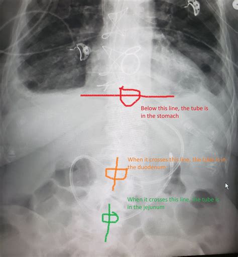 Ligament Of Treitz X Ray Small Bowel Atresias: A Case Series With