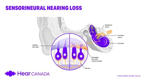 What is sensorineural hearing loss? Causes, signs & treatment