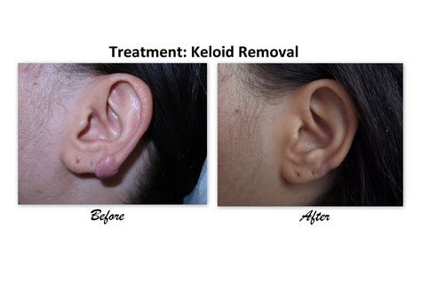When Does Keloid Happen