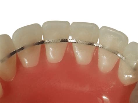 Image result for Retainer Problems