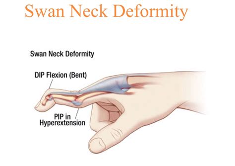 Define The Swan Neck Deformity at Finn Morgan blog