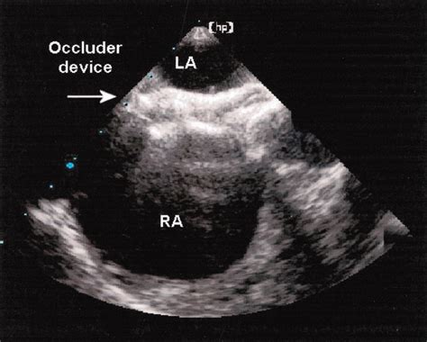 Transesophageal Echocardiography | Circulation