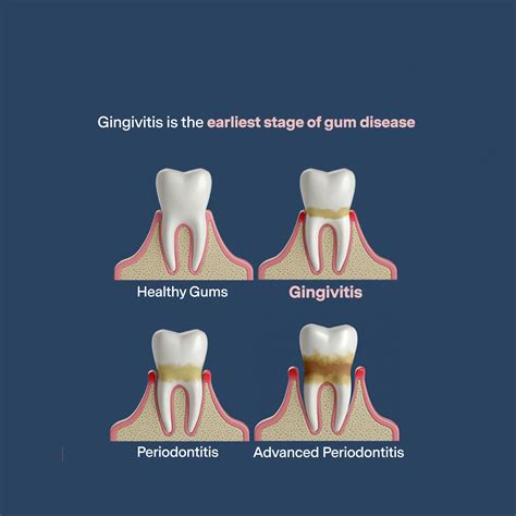 A Comprehensive Guide to Gingivitis