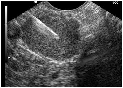 Clinical Management of Bile Duct Diseases: Role of Endoscopic ...