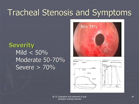 PPT - Evaluation and treatment of post intubation tracheal stenosis PowerPoint Presentation - ID ...