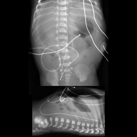 Premature newborn with abdominal distension after nasogastric tube ...