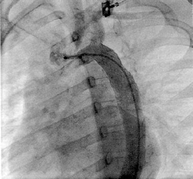Indian Heart Jouranl 353-357