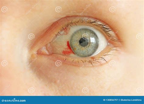 Eyelid With Blood Vessels Veins Royalty-Free Stock Photography | CartoonDealer.com #12722711