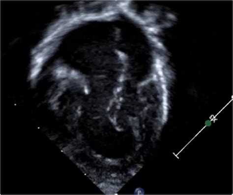 Imaging of Double Inlet Left Ventricle - Seminars in Thoracic & Cardiovascular Surgery ...