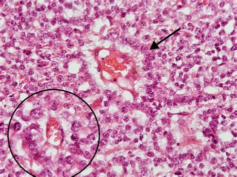 @pathology_case.review | ‎Bodies of pathology 🔬 Schiller-Duval Body ...