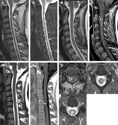 Spinal cord involvement in multiple sclerosis and neuromyelitis optica spectrum disorders - The ...