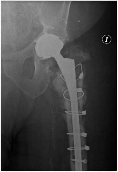 One-Stage Hip Revision Arthroplasty Using Megaprosthesis in Severe Bone ...