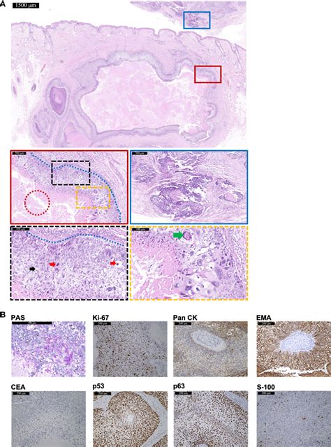 Xeroderma Pigmentation