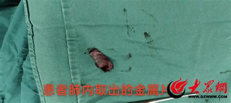 菏泽市创伤医院多学科抢救一名重度胸部复合伤患者_菏泽新闻_大众网菏泽