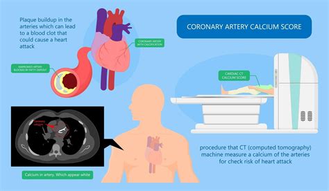 Understanding - CARDIAC CT FOR CALCIUM SCORING | MRI PLUS