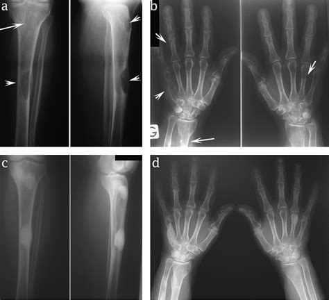Scintigraphic findings in hungry bone syndrome following parathyroidectomy | Revista Española de ...